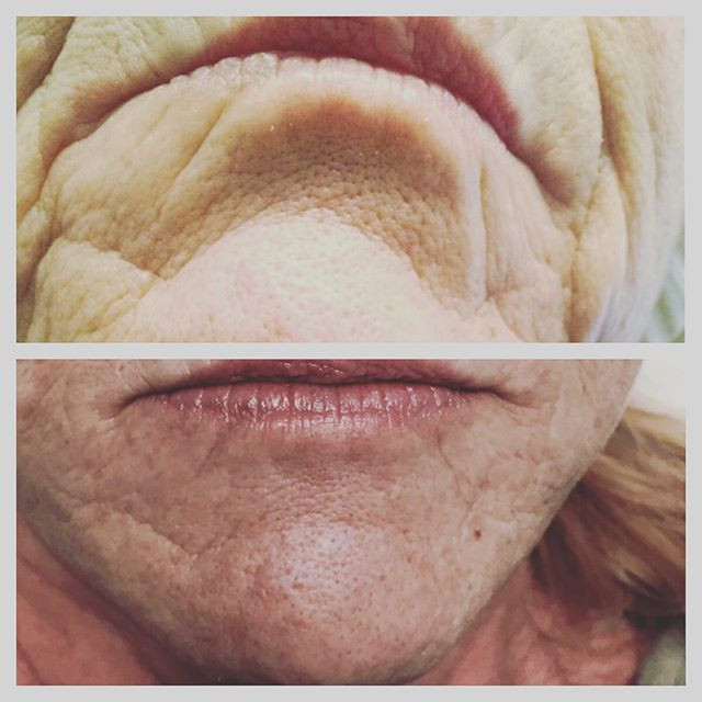 PhotoFacial for wrinkles and scarring