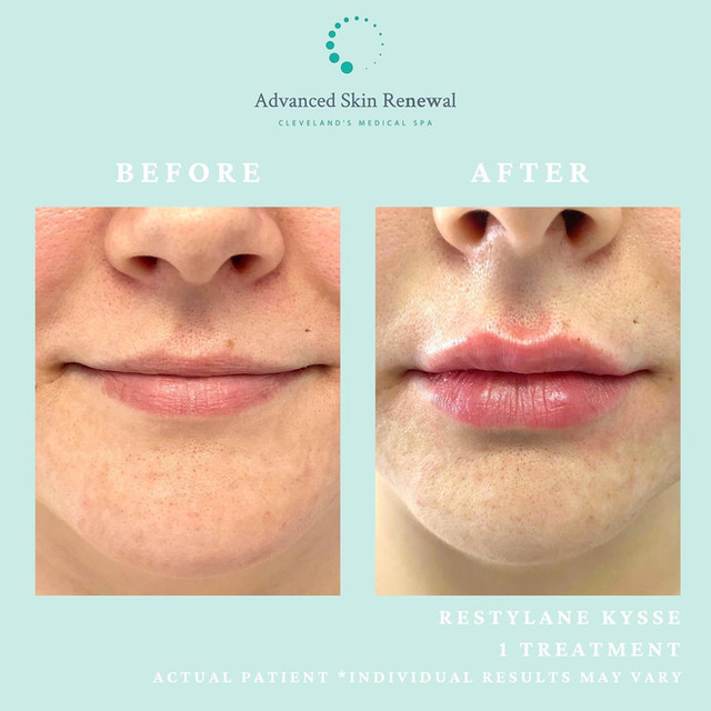 Before and after restylane kysse lip filler with Julia Horne Technique.