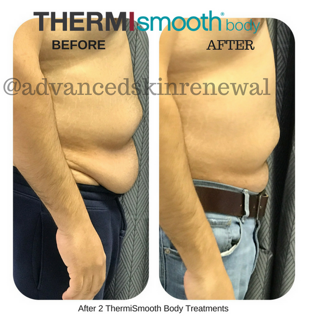 ThermiSmooth Body can sculpt and reduce cellulite.