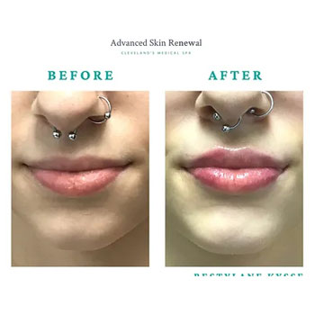 Before and after lip filler