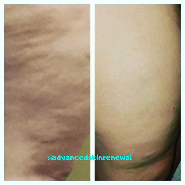 before and after with ThermiSmooth for cellulite reduction