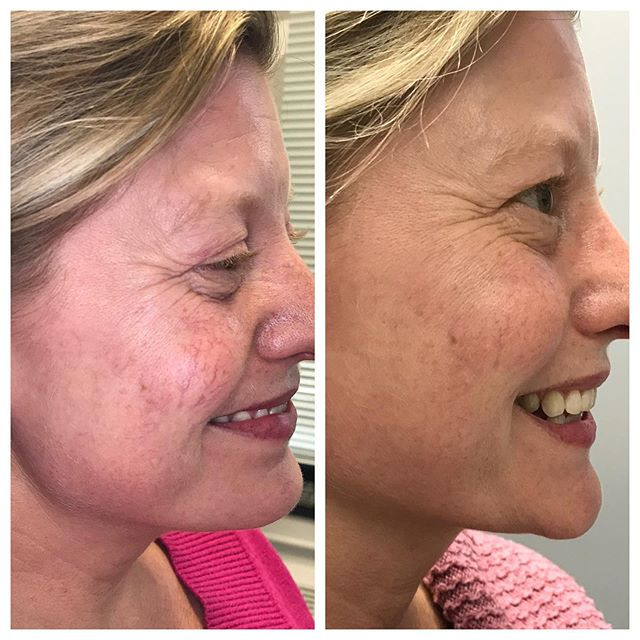 Facial Vein Removal Before After
