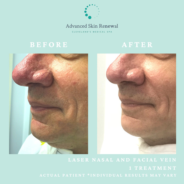 Laser vein removal and rosacea