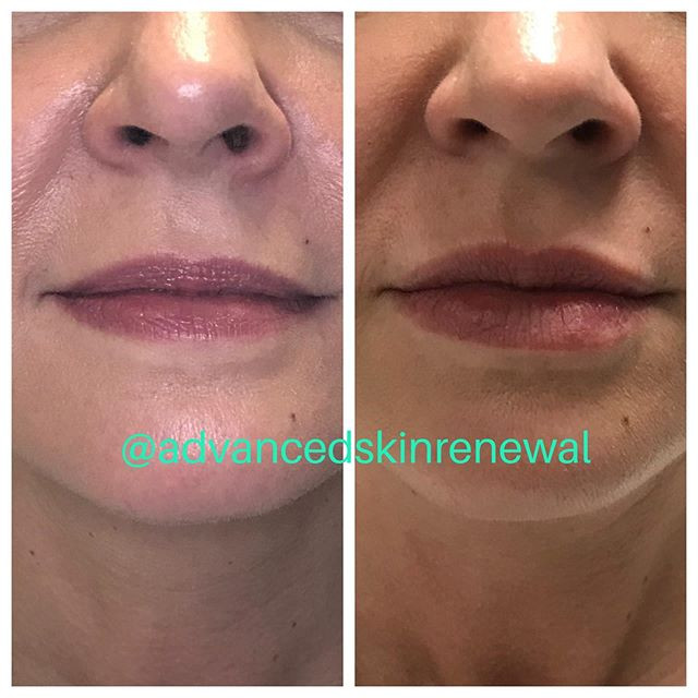 Before and after lip filler. Restylane