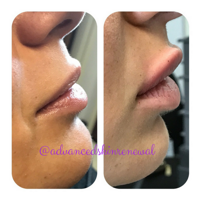 Before and After Lip Augmentation.