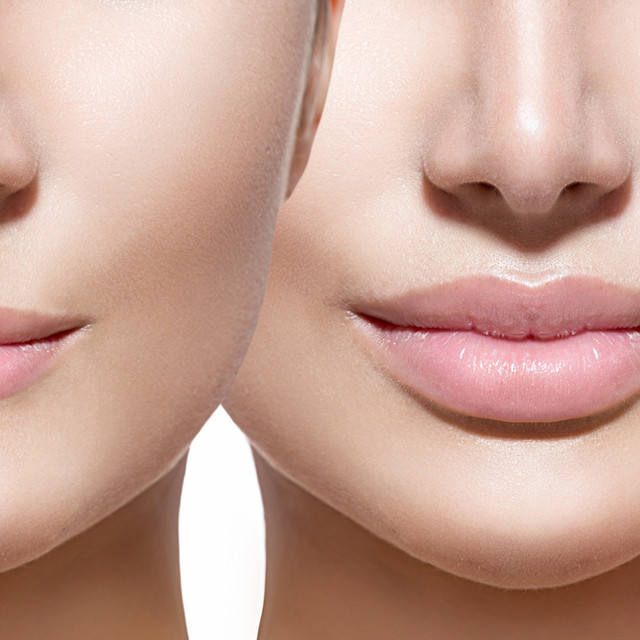 Before and After lip augmentation