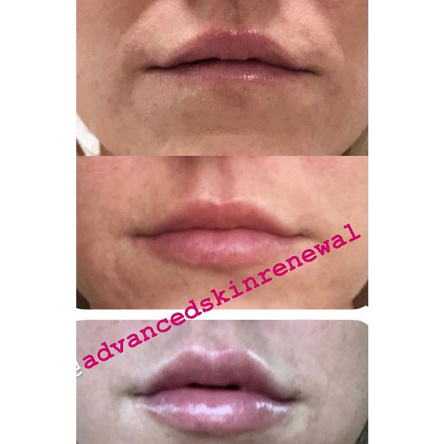 Before and after Resytlane Defyne injection for the lip.