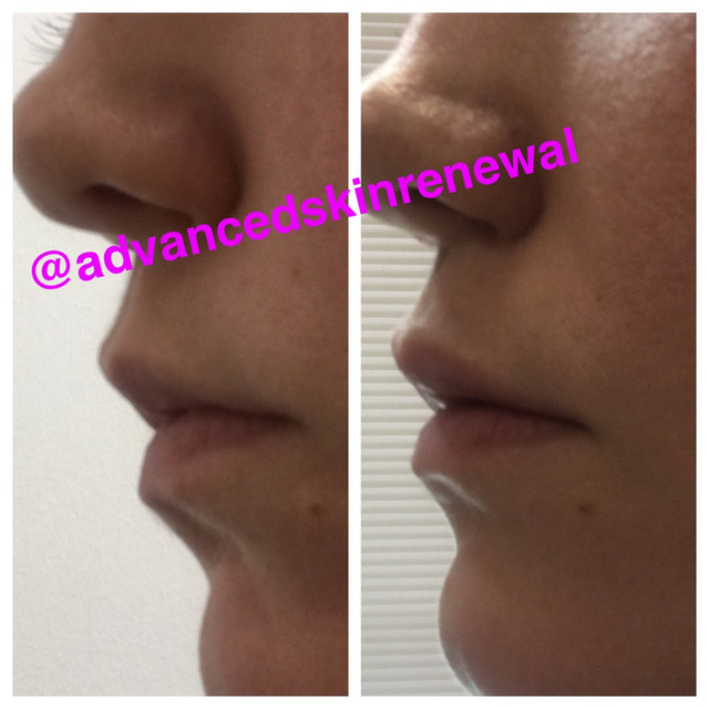 Before and after Restylane Defyne .5ml