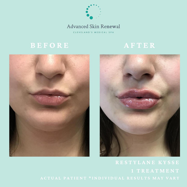 Before and After with Restylane lip filler.