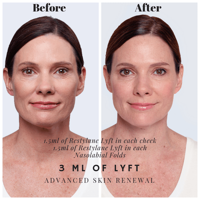Before and after Restylane Lyft injections to reduce frown lines and deep folds and wrinkles.