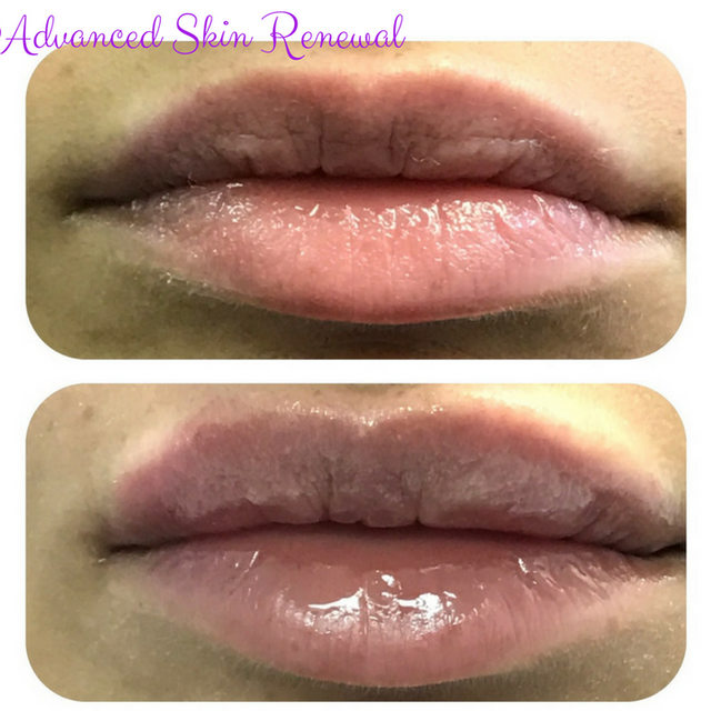 Get the lip augmentation you desire, used 1ml of Restylane Silk to create the perfect pout.