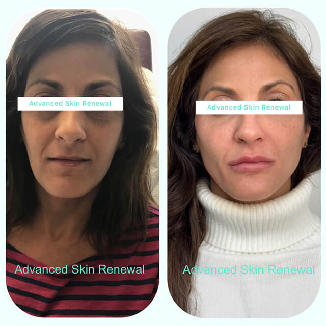Sculptra and Lip Injections Before & After - Case-1